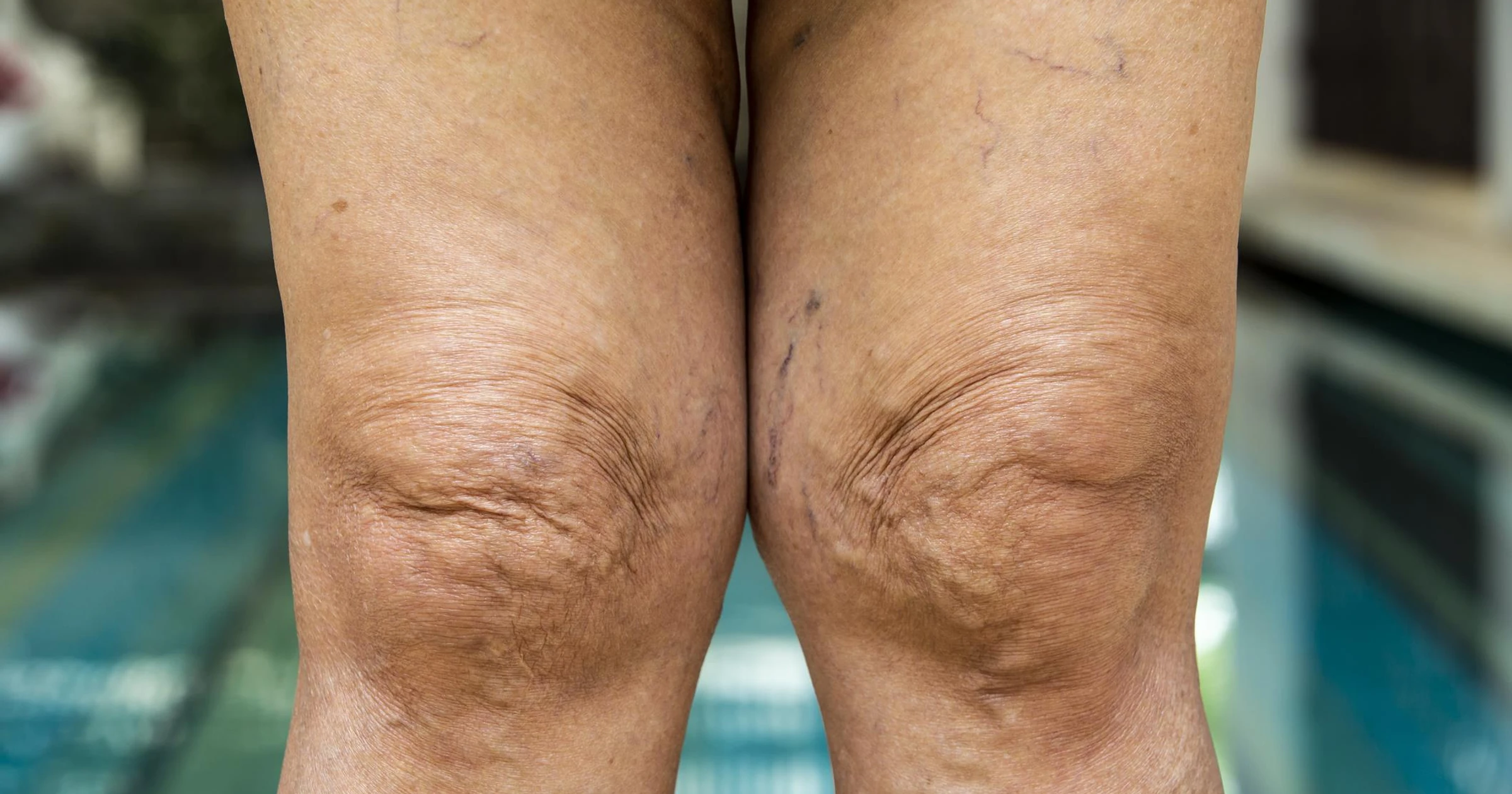 Mikroskopowe zdjęcie uszkodzonych naczyń krwionośnych z blaszkami miażdżycowymi.