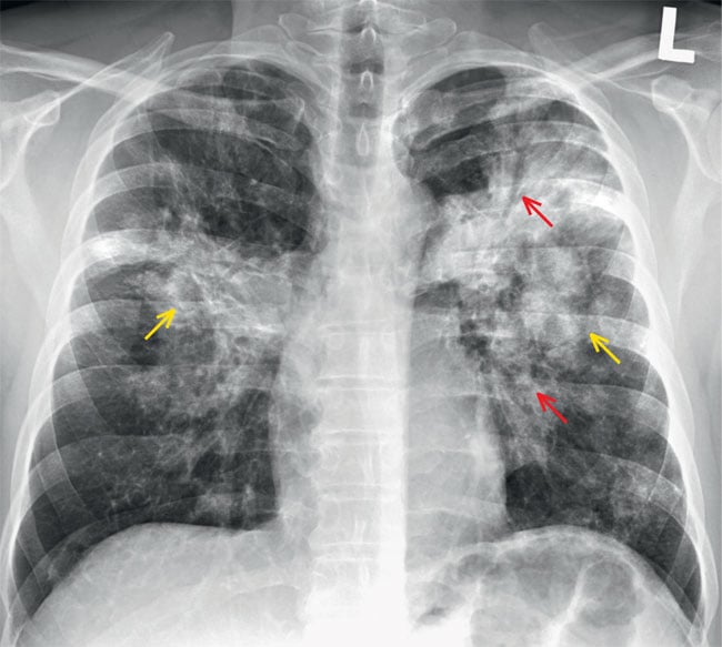 Obraz pękającej szklanej tafli, za którą widać zarysy płuc lub klatki piersiowej, symbolizujący pierwsze sygnały problemów zdrowotnych.
