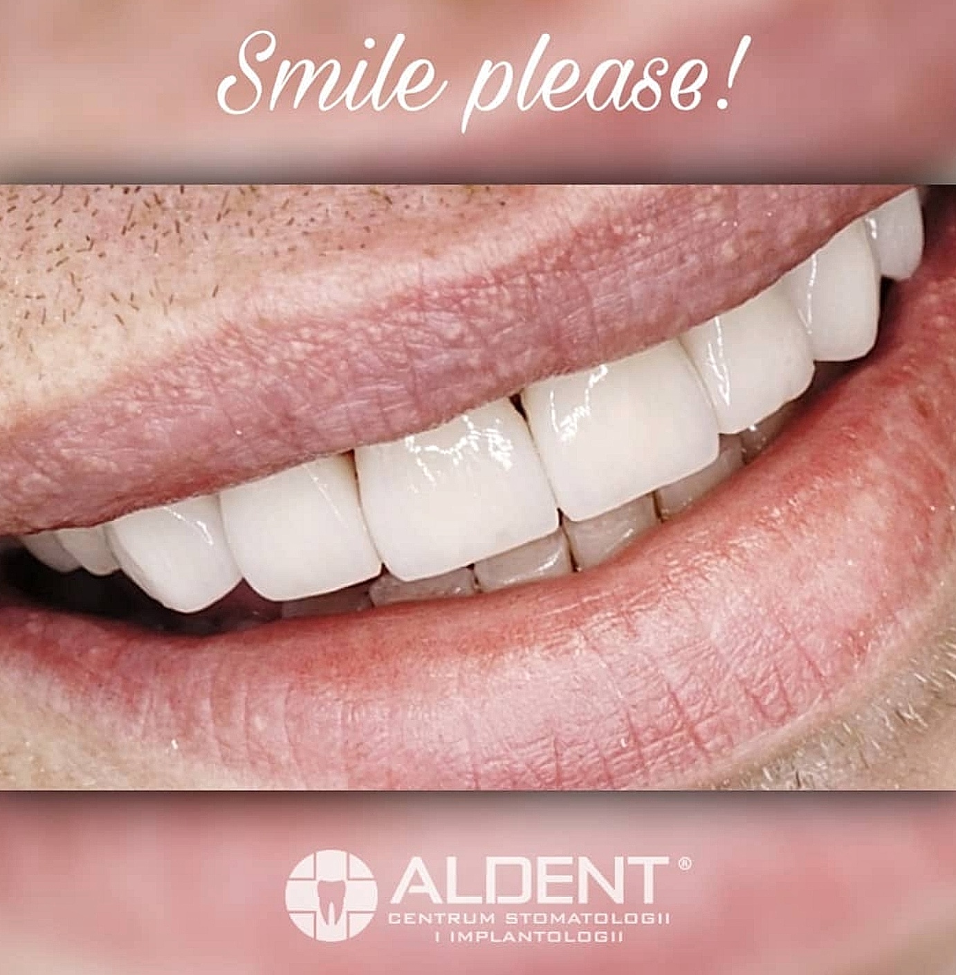 uśmiech Hollywood e-papieros zęby dentysta porównanie białe żółte - Hollywood Smile - dlaczego jest tak pożądany? - Aldent