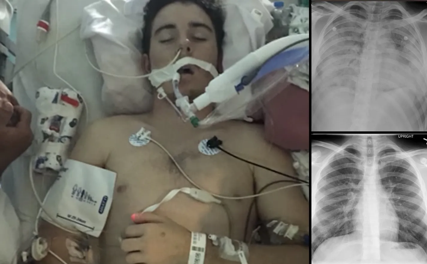 EVALI objawy płucne, choroba płuc vaping, Octan Witaminy E zagrożenie, uszkodzone płuca medycyna - E-papierosy mogą powodować śmierć i choroby płuc. Sześć osób nie ...