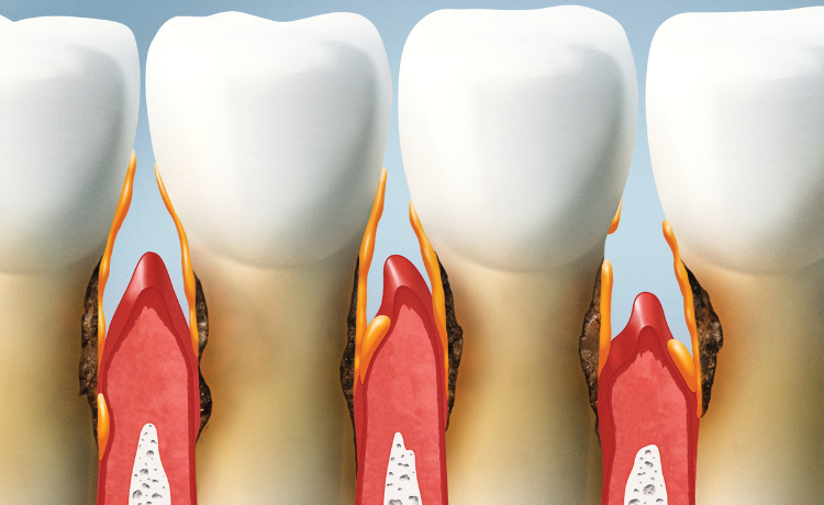 recesja dziąseł diagram, cofające się dziąsła ilustracja, zdrowe dziąsła vs chore dziąsła, anatomia przyzębia - Recesja dziąseł – co oznacza cofanie dziąseł? - DentiLove.pl