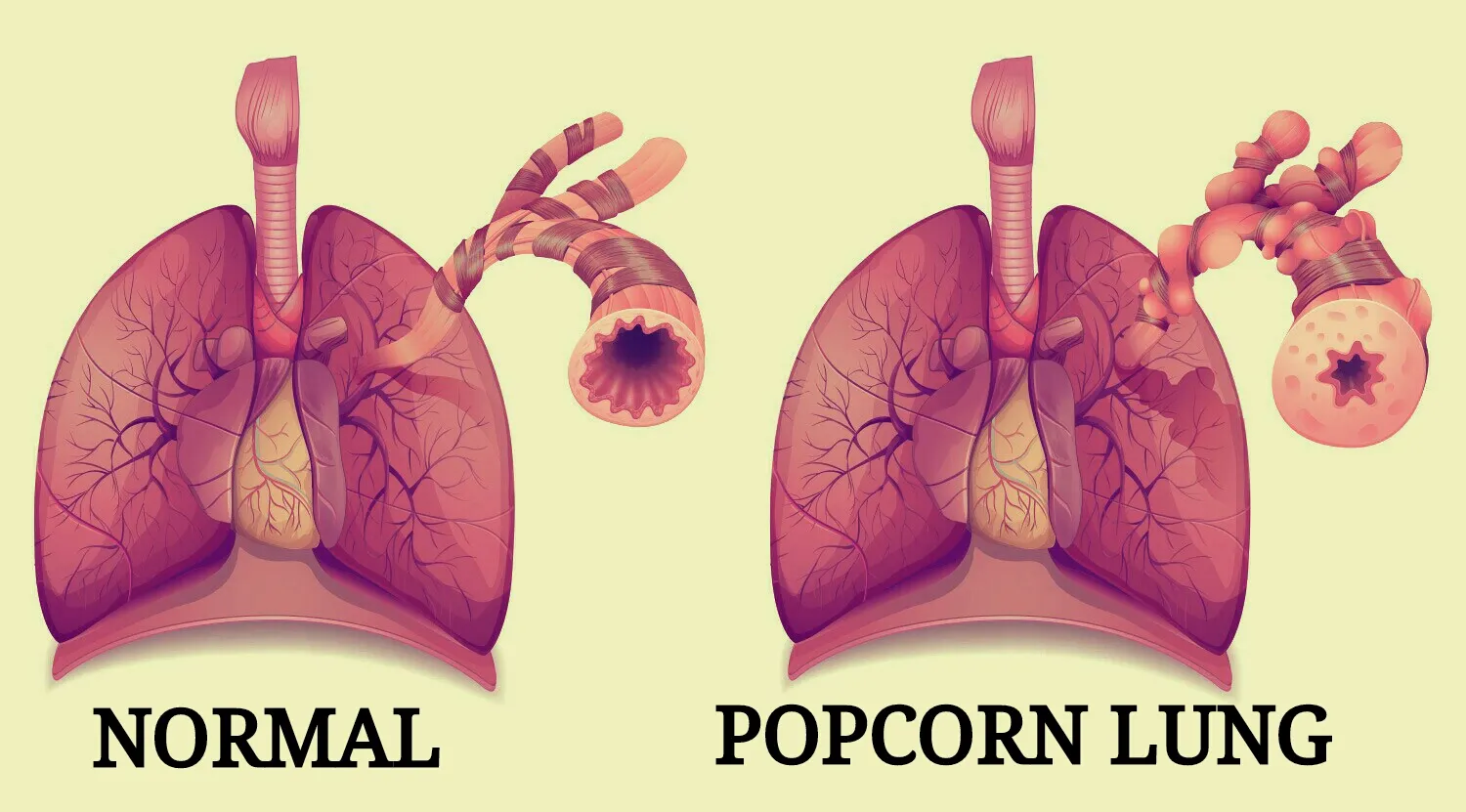 Ilustracja przedstawiająca uszkodzone płuca z elementami nawiązującymi do popcornu, symbolizująca zarostowe zapalenie oskrzelików spowodowane diacetylem z e-papierosów.